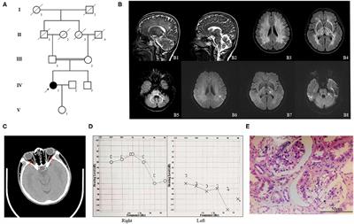 Case Report: A Homozygous Mutation (p.Y62X) of Phospholipase D3 May Lead to a New Leukoencephalopathy Syndrome